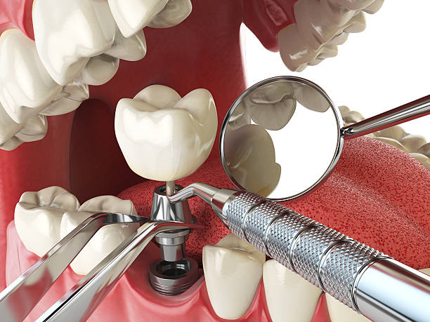 Best Emergency Dentist for Knocked-Out Tooth in Riviera Beach, FL